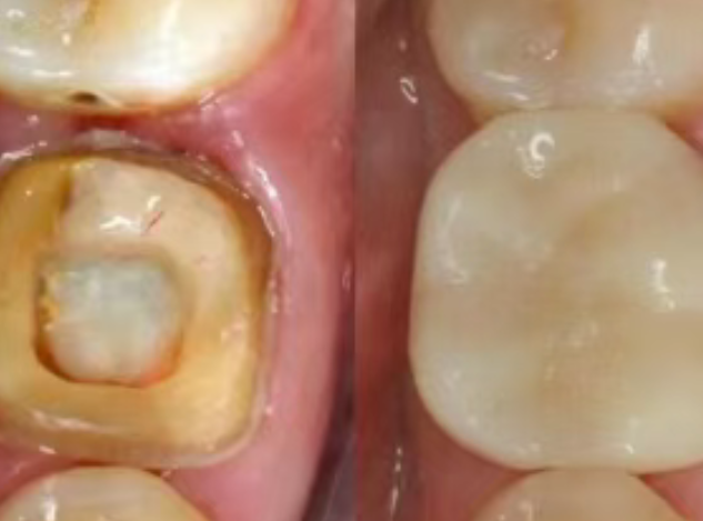 根管治療（抽神經(jīng)）后，為什么一定要做牙冠？