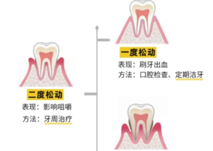 老年人牙齒松動(dòng)了要怎么辦？