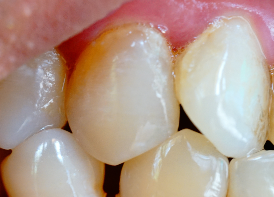 牙齒表面的牙釉質(zhì)掉了還可以修復嗎？