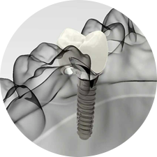 術(shù)前研究、模擬提升種植成功率